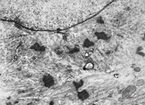 F,56y. | nemaline myopathy v.s.